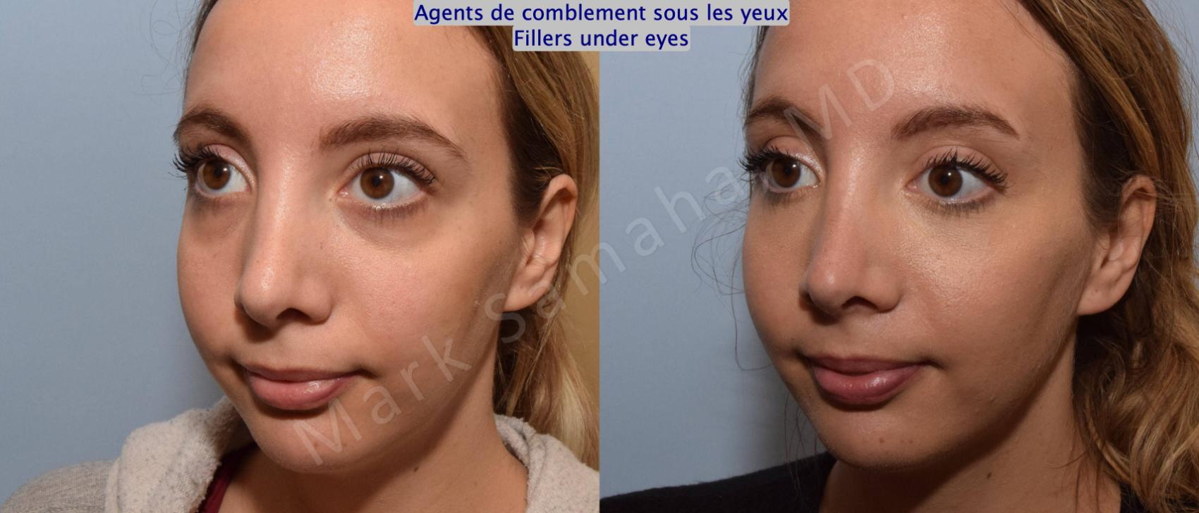 Before & After Agents de Comblement-Remplisseurs / Dermal Fillers Case 166 Left Oblique View in Mount Royal, QC