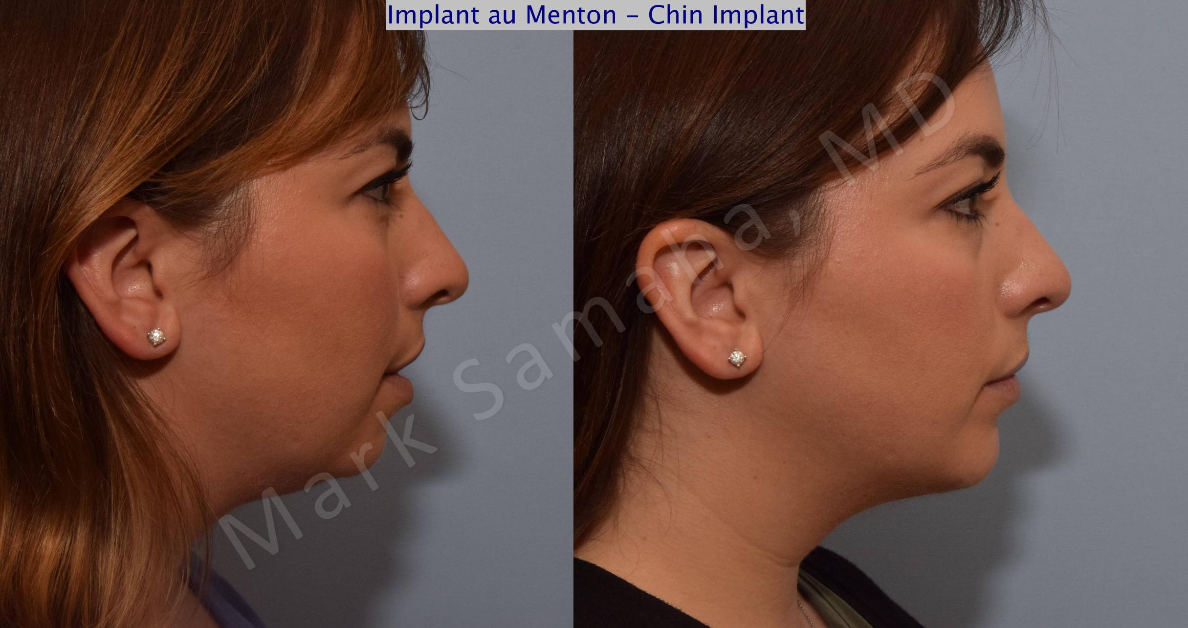 Before & After Augmentation du menton / Chin Augmentation Case 104 View #1 View in Mount Royal, QC