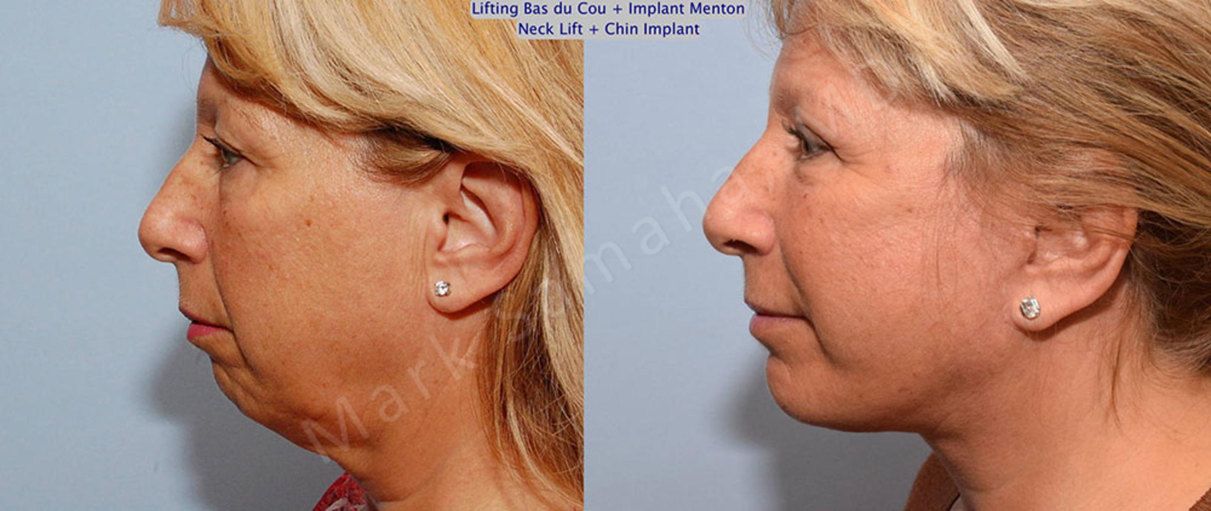 Before & After Augmentation du menton / Chin Augmentation Case 28 View #1 View in Mount Royal, QC