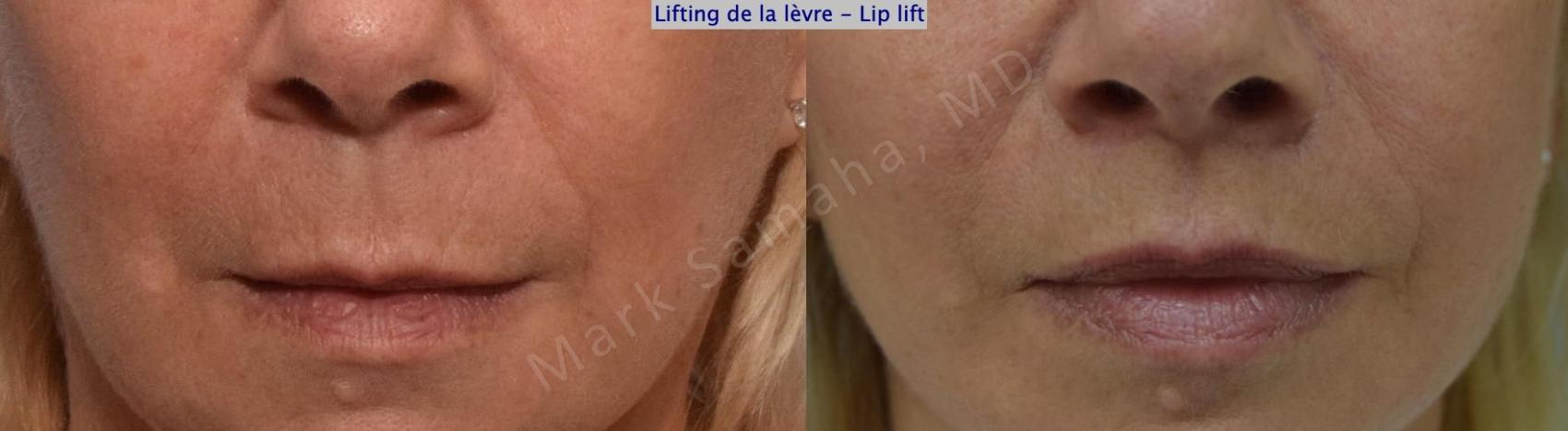 Before & After Lifting de la lèvre supérieure / Lip Lift Case 169 Front View in Mount Royal, QC