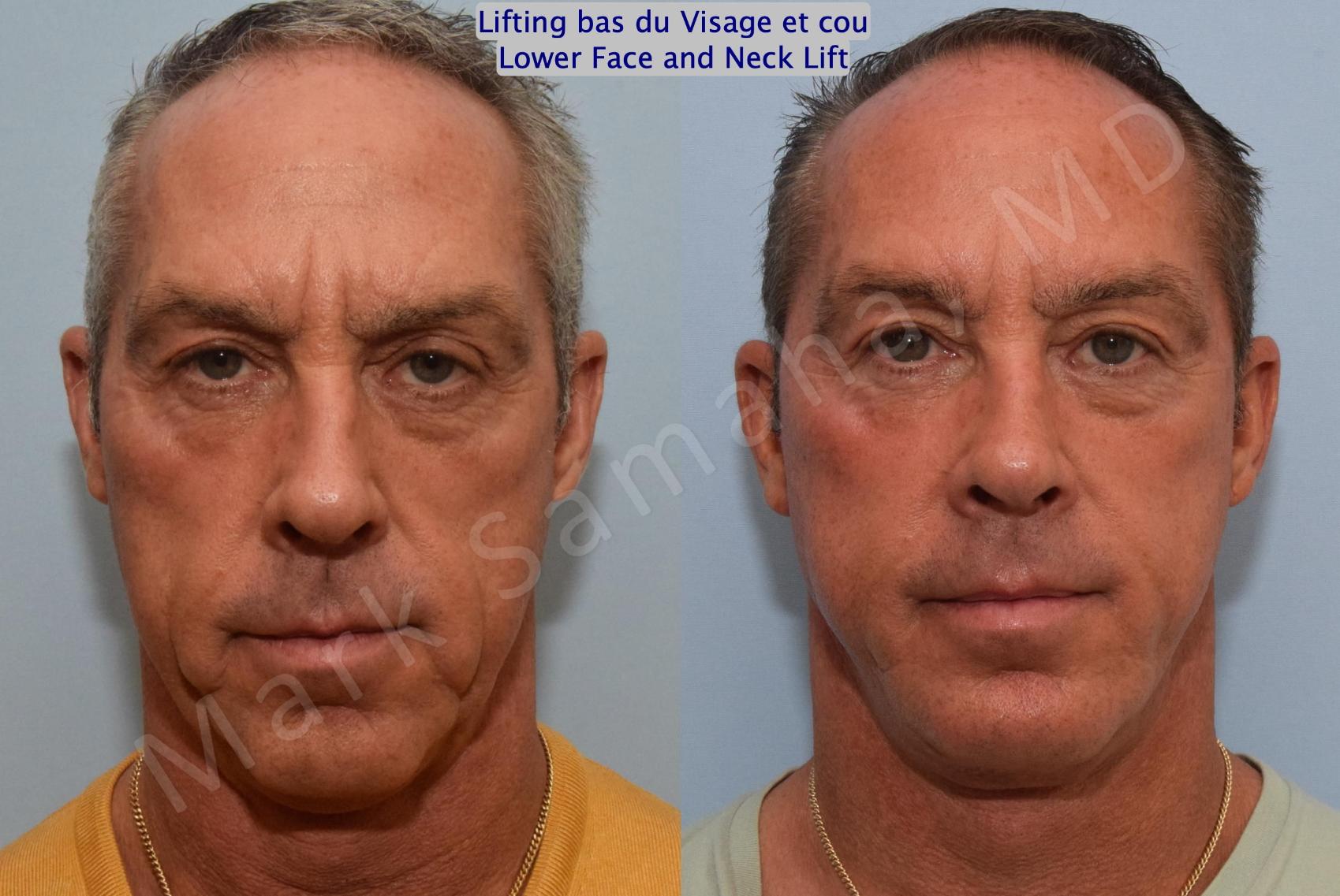 Before & After Lifting du visage / Cou - Facelift / Necklift Case 154 Front View in Mount Royal, QC