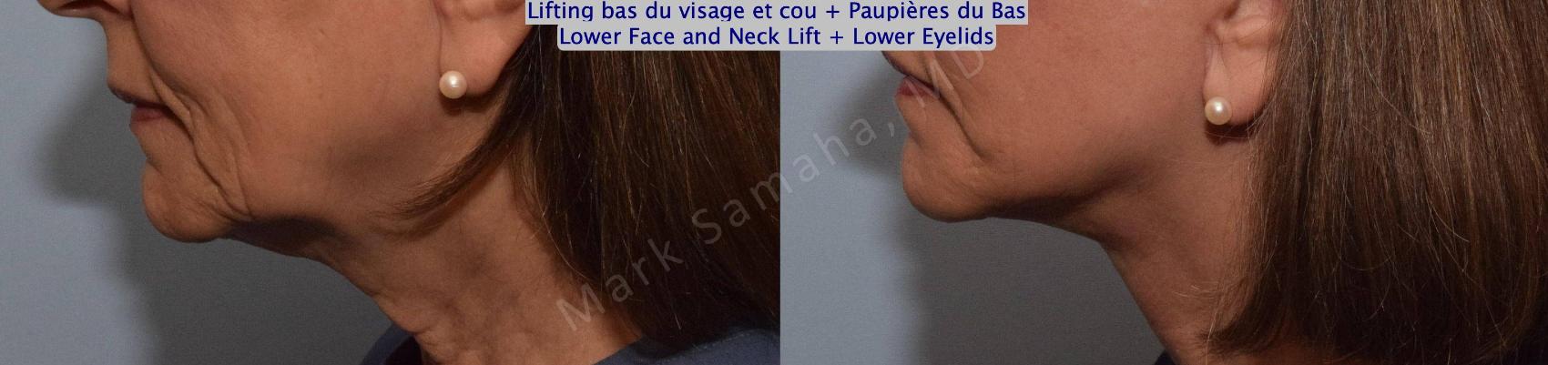 Before & After Lifting du visage / Cou - Facelift / Necklift Case 162 Left Side View in Mount Royal, QC