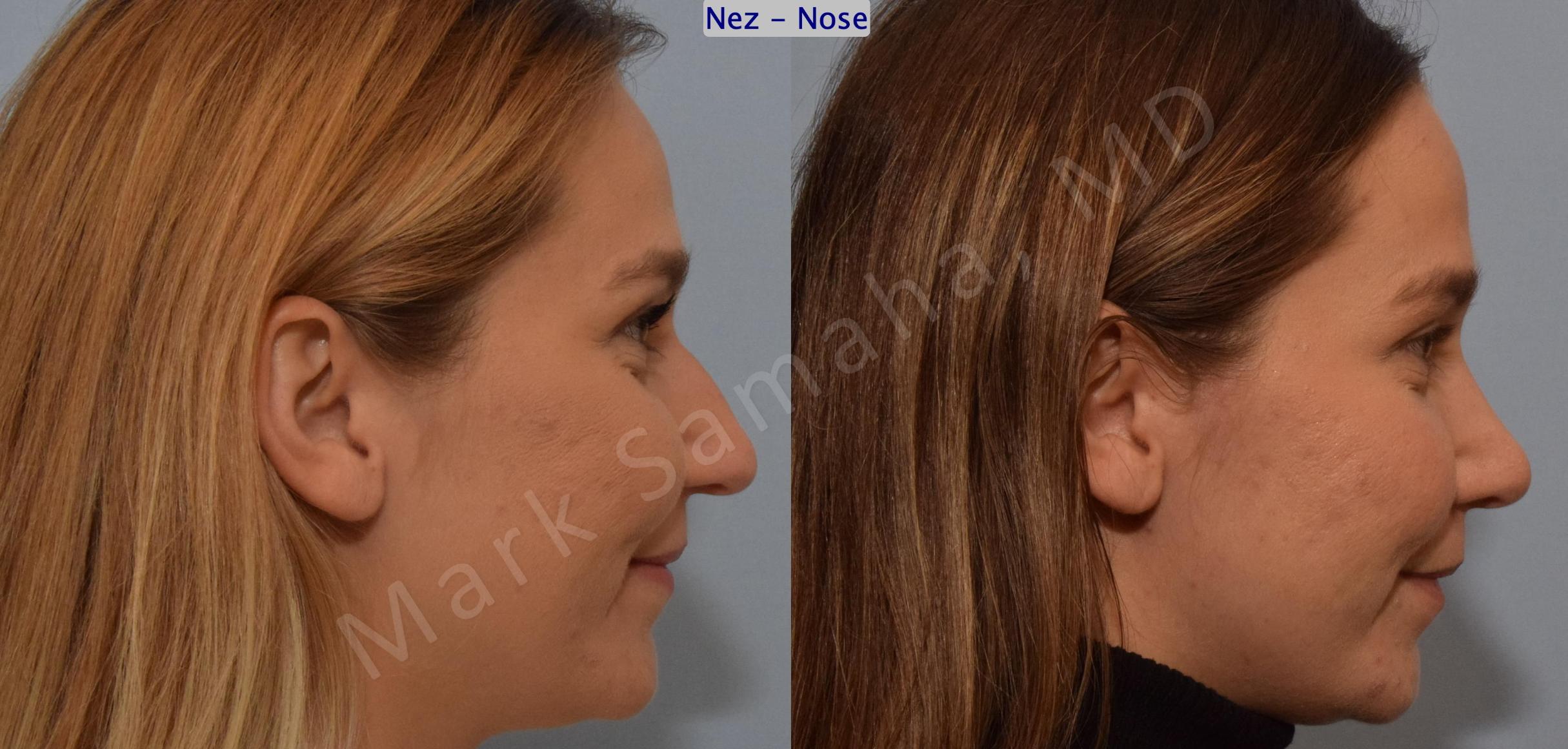 Before & After Rhinoplastie / Rhinoplasty Case 194 Right Side Smile View in Mount Royal, QC