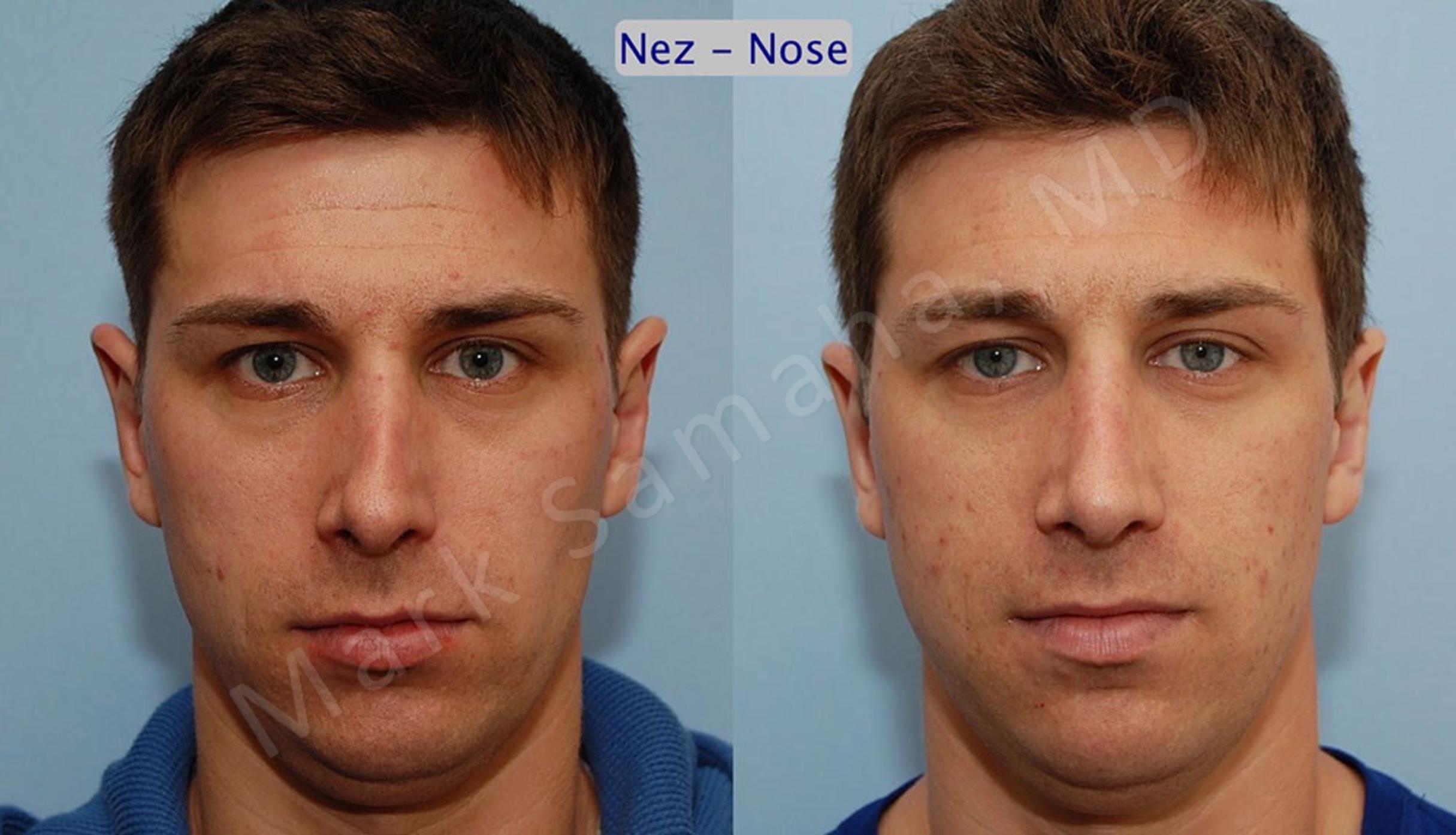 Before & After Rhinoplasty / Rhinoplastie Case 44 View #1 View in Mount Royal, QC