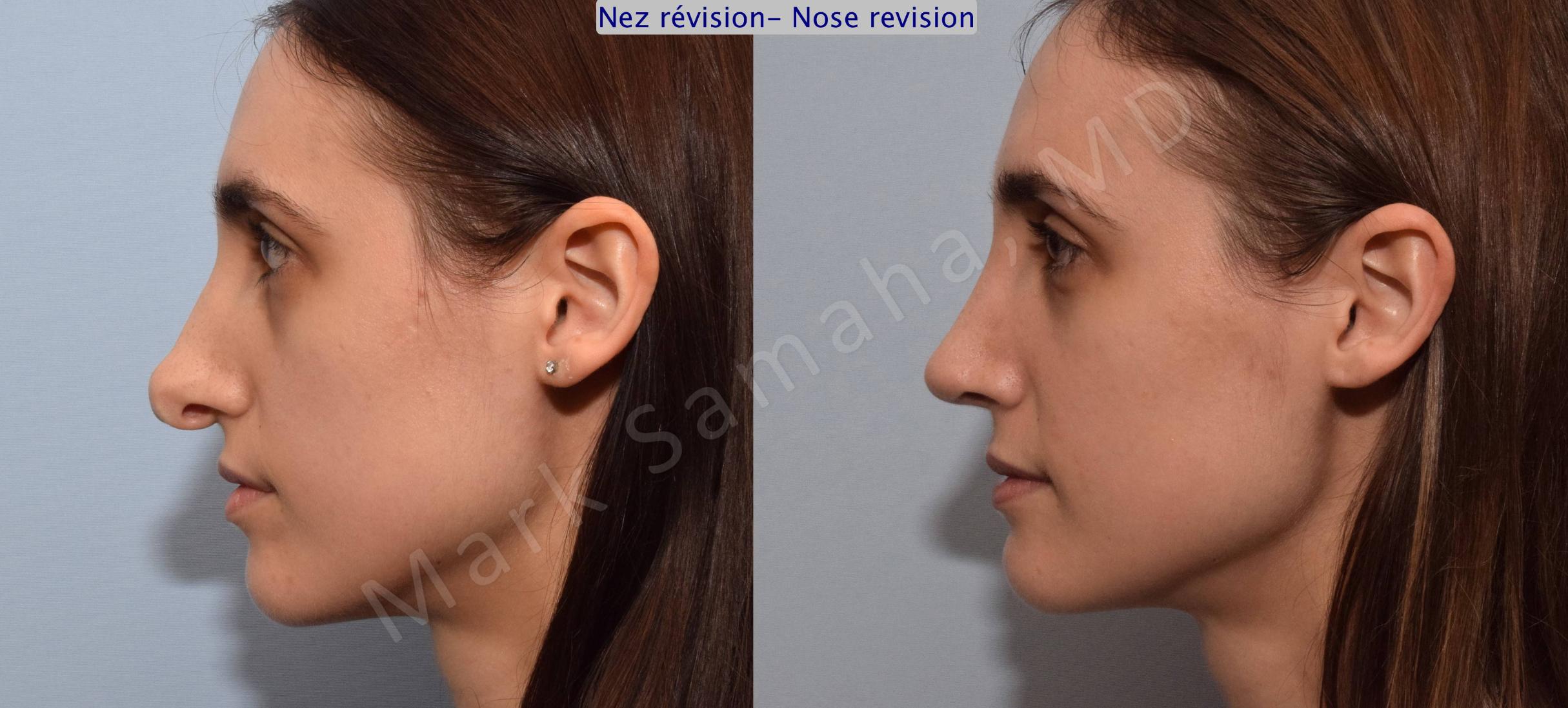 Before & After Rhinoplasty / Rhinoplastie Case 75 View #2 View in Mount Royal, QC