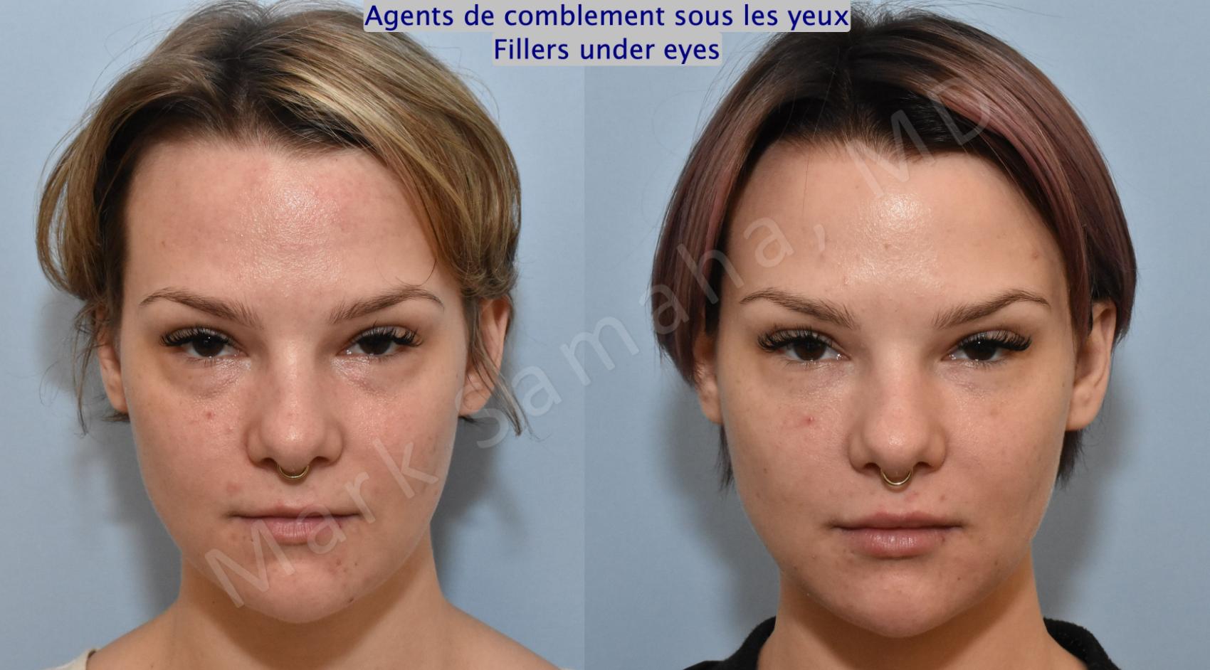 Before & After Agents de Comblement-Remplisseurs / Dermal Fillers Case 165 Front View in Montreal, QC