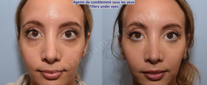 Before & After Agents de Comblement-Remplisseurs / Dermal Fillers Case 166 Front View in Montreal, QC