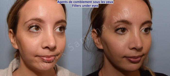 Before & After Agents de Comblement-Remplisseurs / Dermal Fillers Case 166 Right Oblique View in Montreal, QC