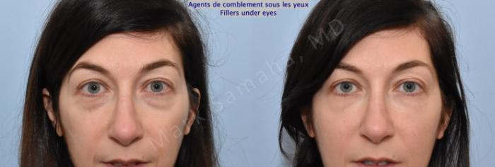 Before & After Agents de Comblement-Remplisseurs / Dermal Fillers Case 207 Front View in Montreal, QC