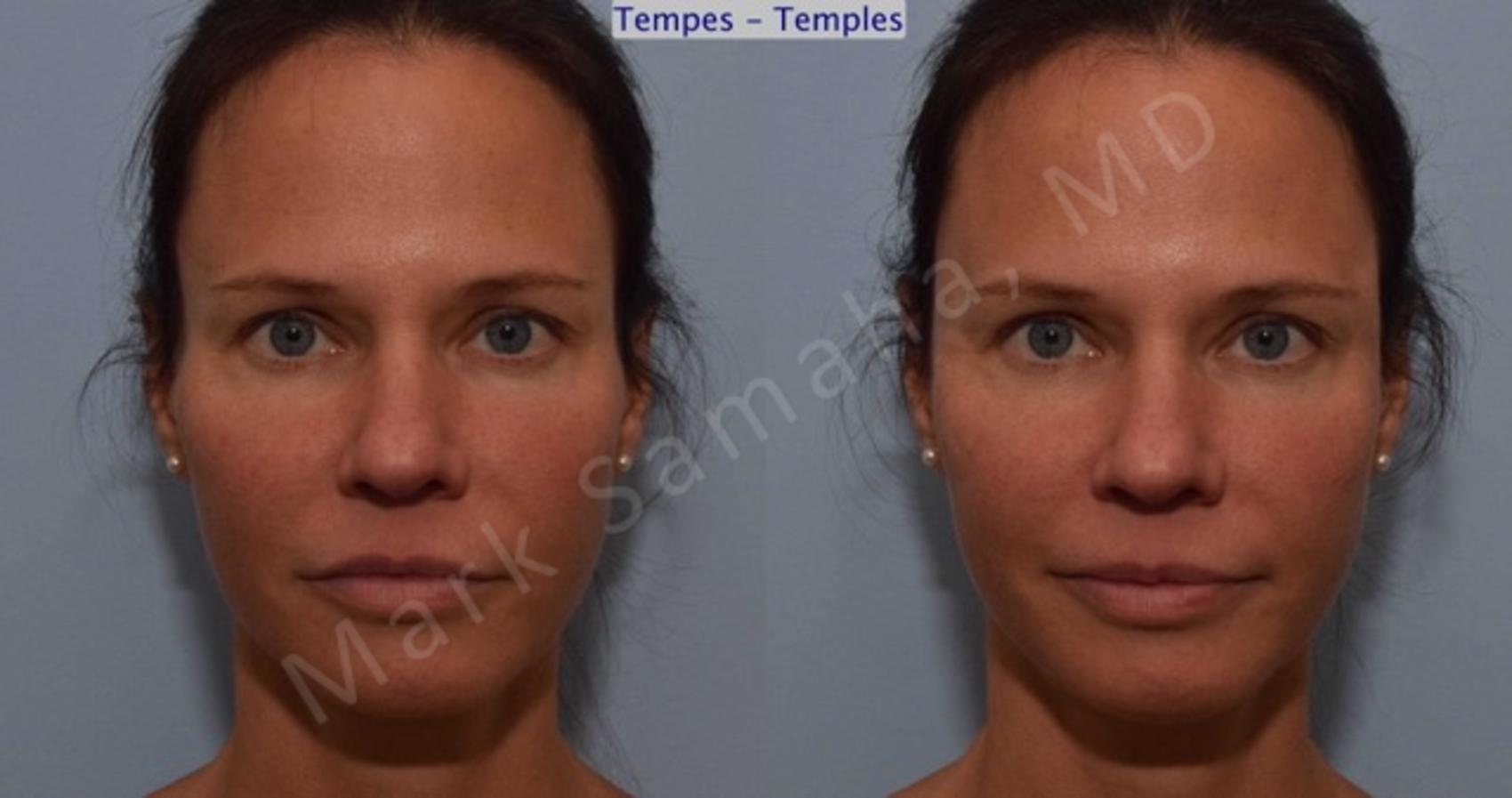 Agents de ComblementRemplisseurs / Dermal Fillers Avant & Après Photos / Before and After Agents de ComblementRemplisseurs / Dermal Fillers Avant & Après Photos / Before and After