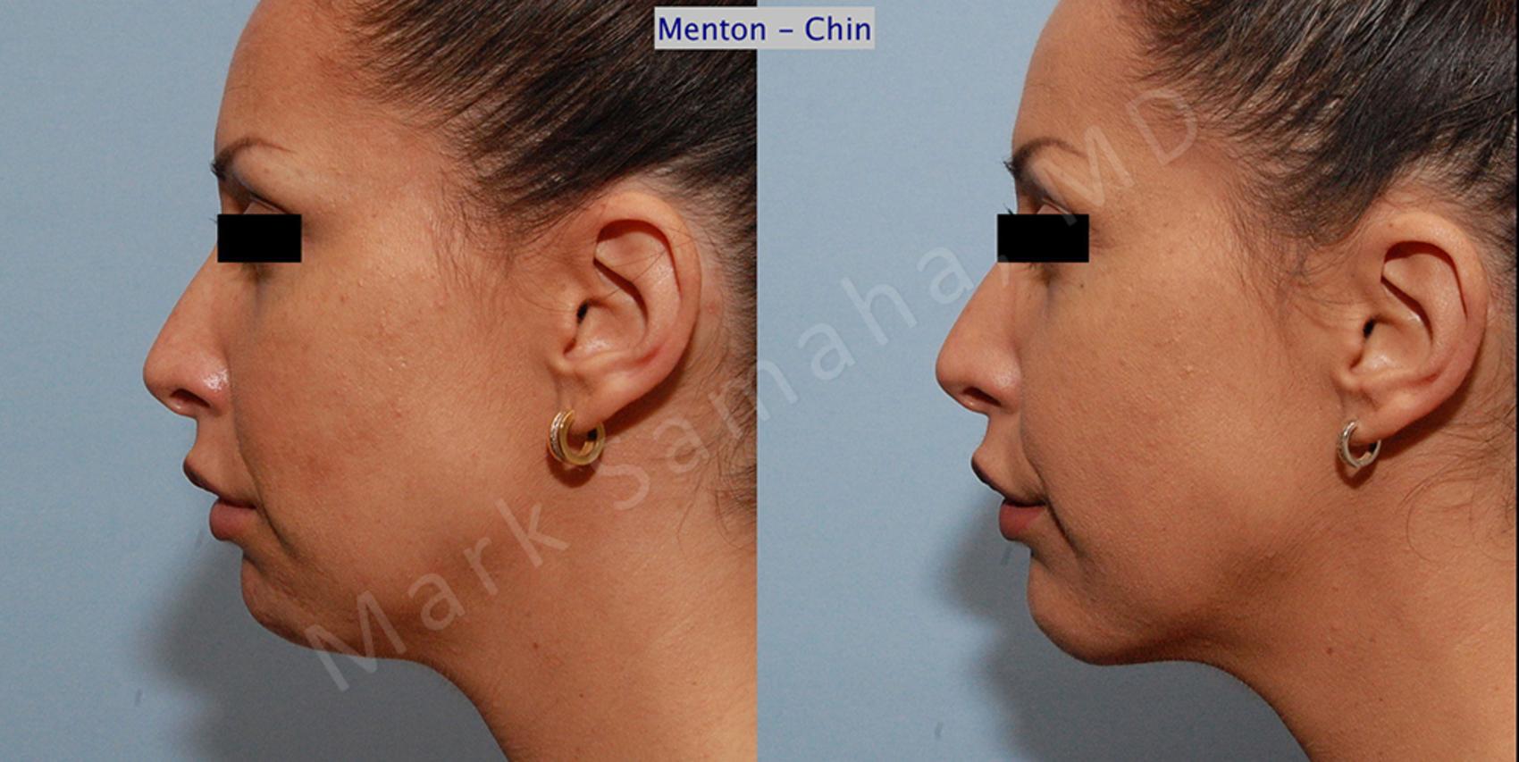 Before & After Augmentation du menton / Chin Augmentation Case 10 View #1 View in Montreal, QC