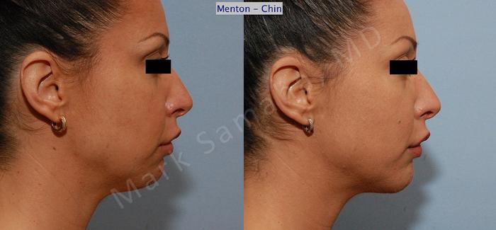 Before & After Augmentation du menton / Chin Augmentation Case 10 View #2 View in Montreal, QC