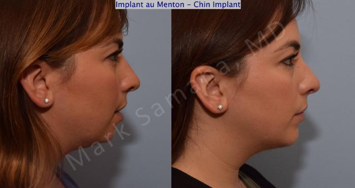 Before & After Augmentation du menton / Chin Augmentation Case 104 View #1 View in Montreal, QC