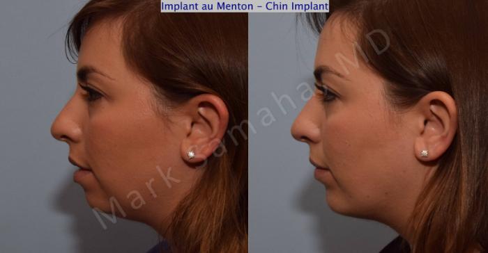 Before & After Augmentation du menton / Chin Augmentation Case 104 View #2 View in Montreal, QC