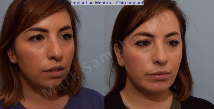 Before & After Augmentation du menton / Chin Augmentation Case 104 View #5 View in Montreal, QC