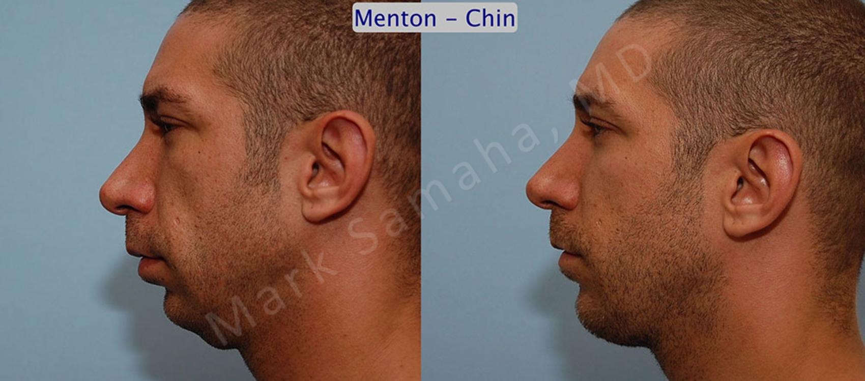 Before & After Augmentation du menton / Chin Augmentation Case 11 View #1 View in Mount Royal, QC