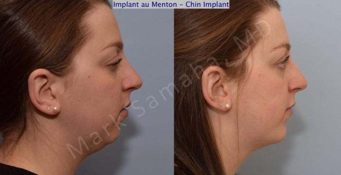 Before & After Augmentation du menton / Chin Augmentation Case 111 View #1 View in Montreal, QC