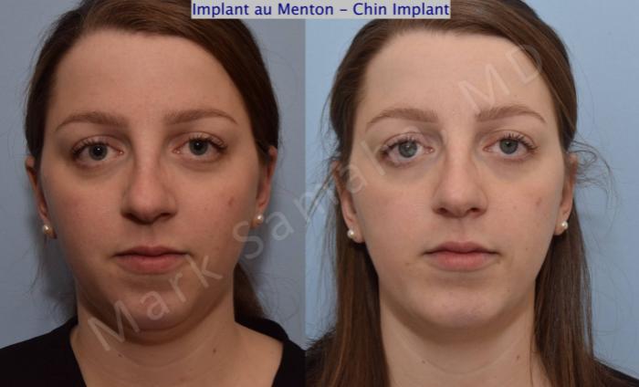 Before & After Augmentation du menton / Chin Augmentation Case 111 View #2 View in Montreal, QC