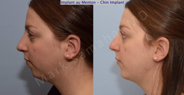Before & After Augmentation du menton / Chin Augmentation Case 111 View #3 View in Montreal, QC