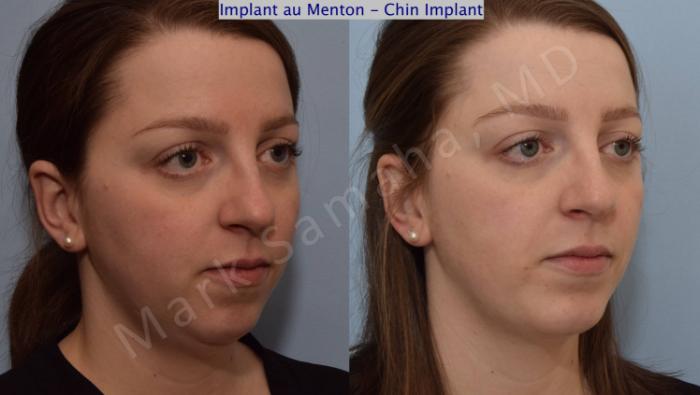 Before & After Augmentation du menton / Chin Augmentation Case 111 View #5 View in Montreal, QC