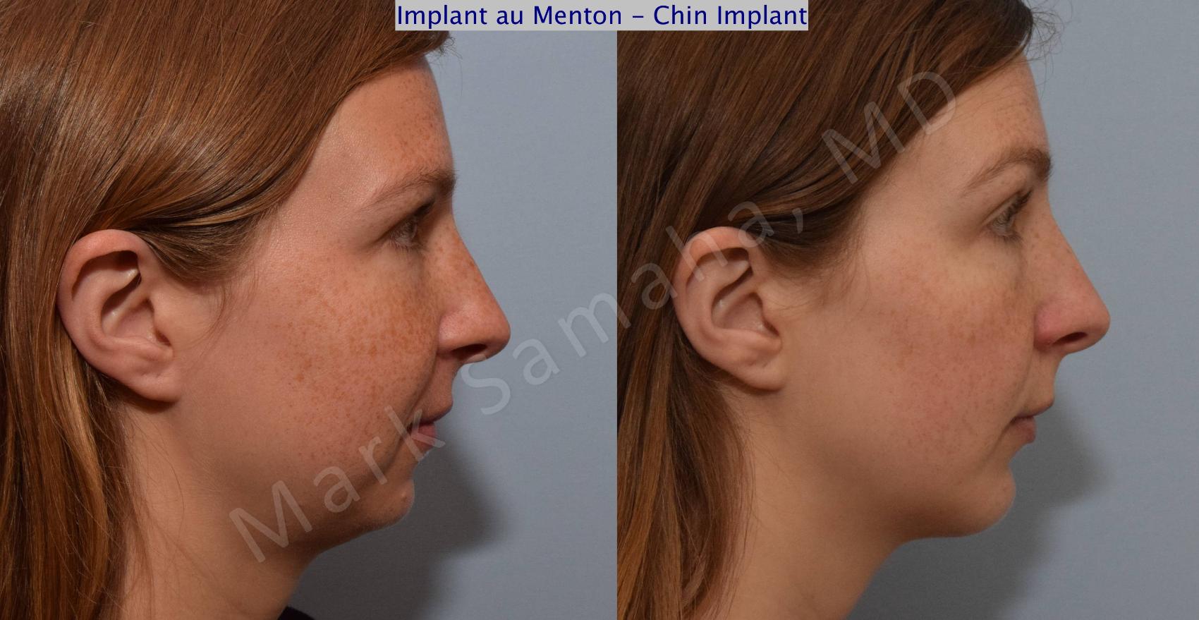 Before & After Augmentation du menton / Chin Augmentation Case 112 View #1 View in Mount Royal, QC