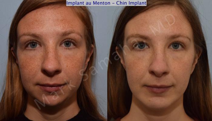 Before & After Augmentation du menton / Chin Augmentation Case 112 View #2 View in Montreal, QC