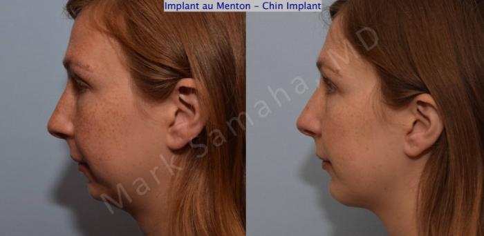 Before & After Augmentation du menton / Chin Augmentation Case 112 View #3 View in Montreal, QC
