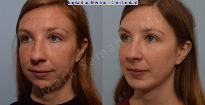 Before & After Augmentation du menton / Chin Augmentation Case 112 View #4 View in Mount Royal, QC