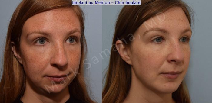 Before & After Augmentation du menton / Chin Augmentation Case 112 View #5 View in Montreal, QC