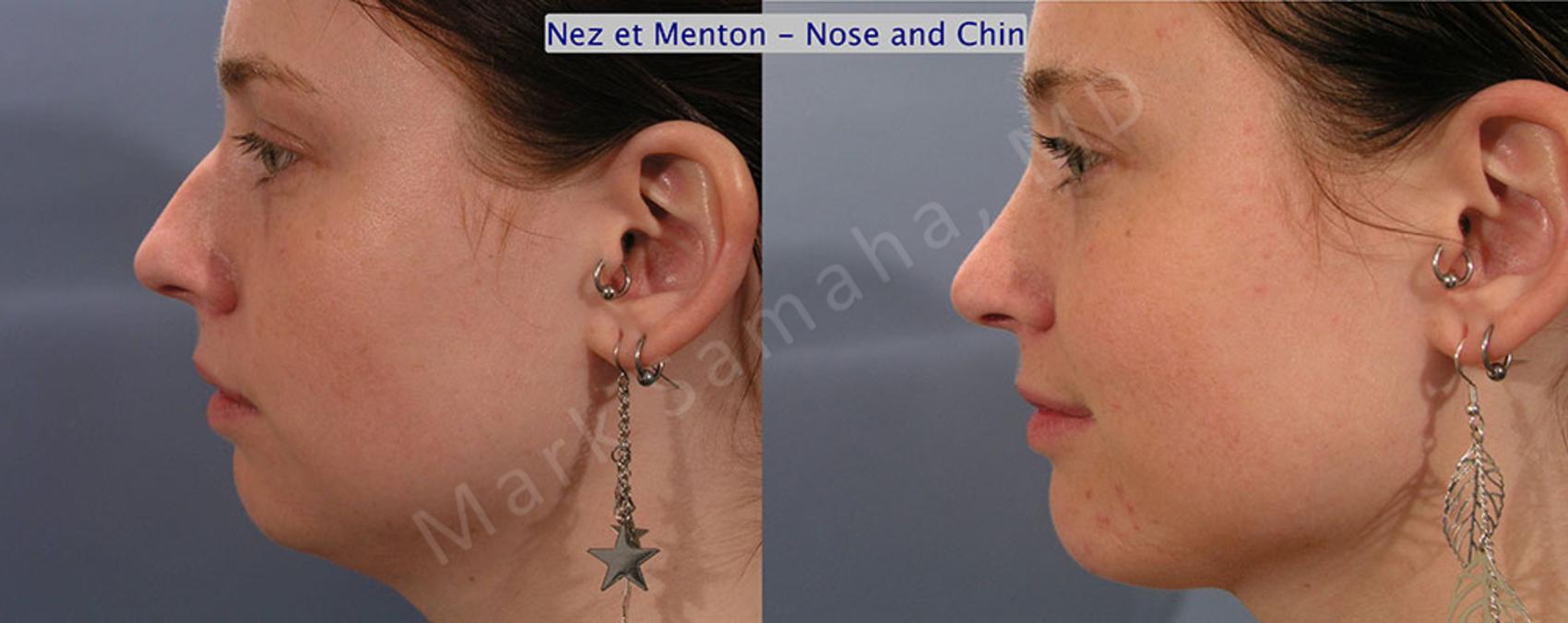 Before & After Augmentation du menton / Chin Augmentation Case 12 View #1 View in Montreal, QC