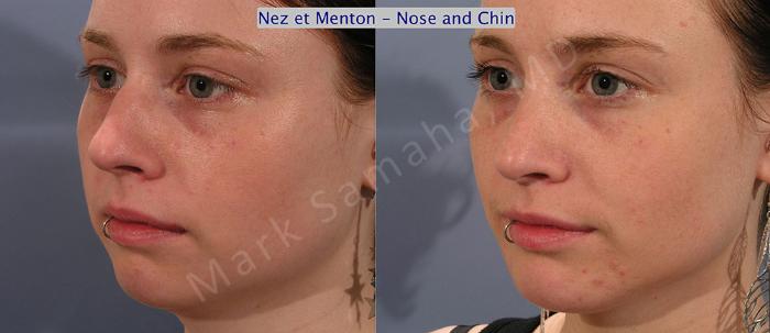 Before & After Augmentation du menton / Chin Augmentation Case 12 View #2 View in Montreal, QC