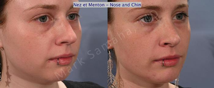 Before & After Augmentation du menton / Chin Augmentation Case 12 View #3 View in Montreal, QC