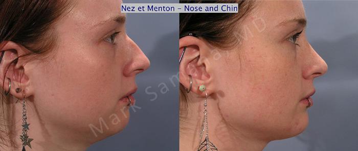 Before & After Augmentation du menton / Chin Augmentation Case 12 View #4 View in Montreal, QC
