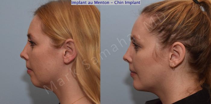 Before & After Augmentation du menton / Chin Augmentation Case 120 View #1 View in Montreal, QC