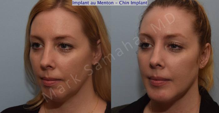 Before & After Augmentation du menton / Chin Augmentation Case 120 View #3 View in Montreal, QC