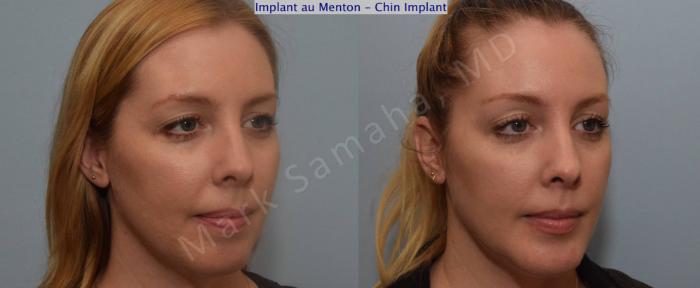 Before & After Augmentation du menton / Chin Augmentation Case 120 View #4 View in Montreal, QC