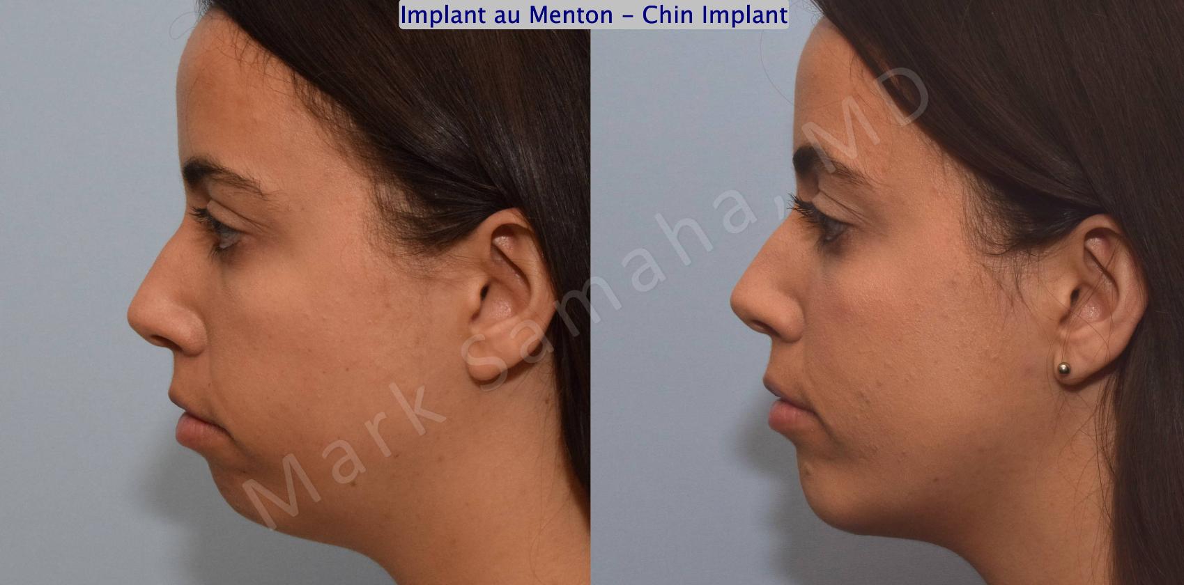 Before & After Augmentation du menton / Chin Augmentation Case 121 View #1 View in Montreal, QC