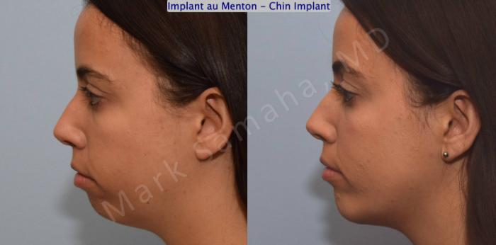 Before & After Augmentation du menton / Chin Augmentation Case 121 View #1 View in Montreal, QC