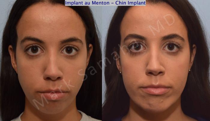 Before & After Augmentation du menton / Chin Augmentation Case 121 View #2 View in Montreal, QC