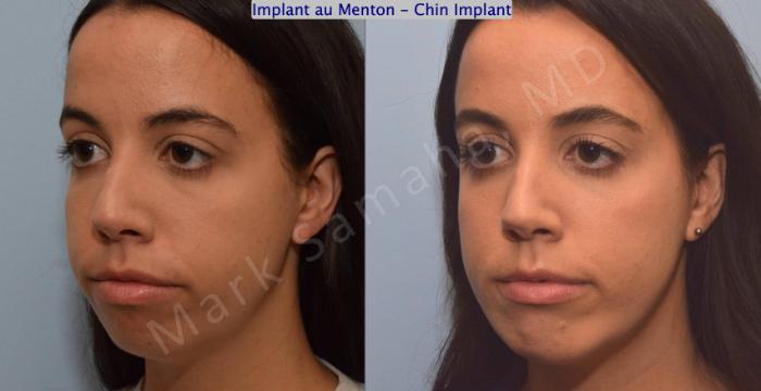 Before & After Augmentation du menton / Chin Augmentation Case 121 View #4 View in Montreal, QC