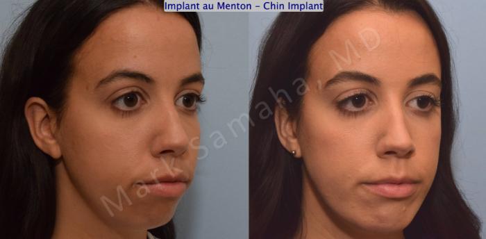 Before & After Augmentation du menton / Chin Augmentation Case 121 View #5 View in Montreal, QC