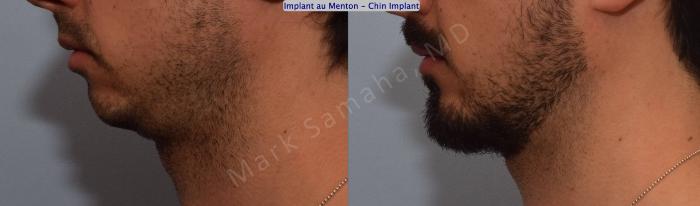 Before & After Augmentation du menton / Chin Augmentation Case 126 View #1 View in Montreal, QC
