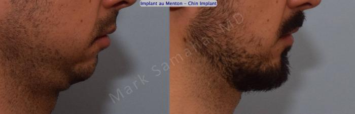 Before & After Augmentation du menton / Chin Augmentation Case 126 View #3 View in Montreal, QC