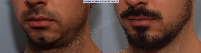 Before & After Augmentation du menton / Chin Augmentation Case 126 View #4 View in Montreal, QC
