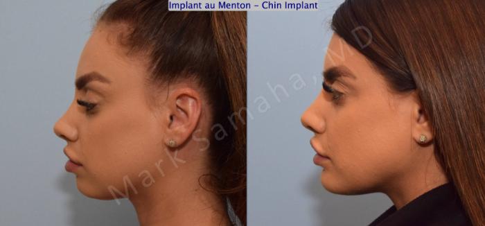 Before & After Augmentation du menton / Chin Augmentation Case 127 View #1 View in Montreal, QC