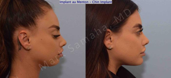 Before & After Augmentation du menton / Chin Augmentation Case 127 View #2 View in Montreal, QC