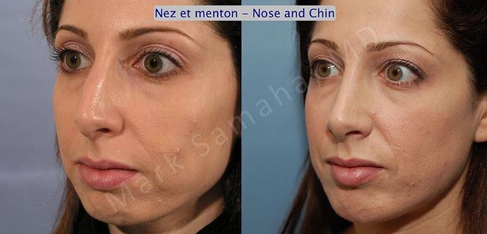 Before & After Augmentation du menton / Chin Augmentation Case 13 View #2 View in Montreal, QC