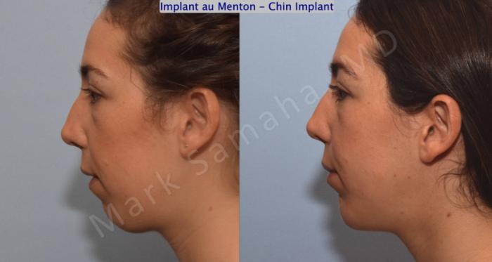 Before & After Augmentation du menton / Chin Augmentation Case 132 View #1 View in Montreal, QC