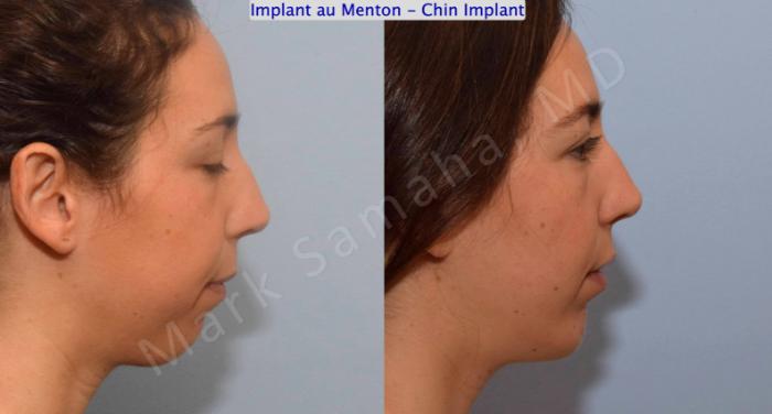 Before & After Augmentation du menton / Chin Augmentation Case 132 View #2 View in Montreal, QC