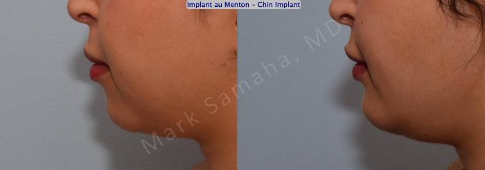 Before & After Augmentation du menton / Chin Augmentation Case 133 View #3 View in Montreal, QC